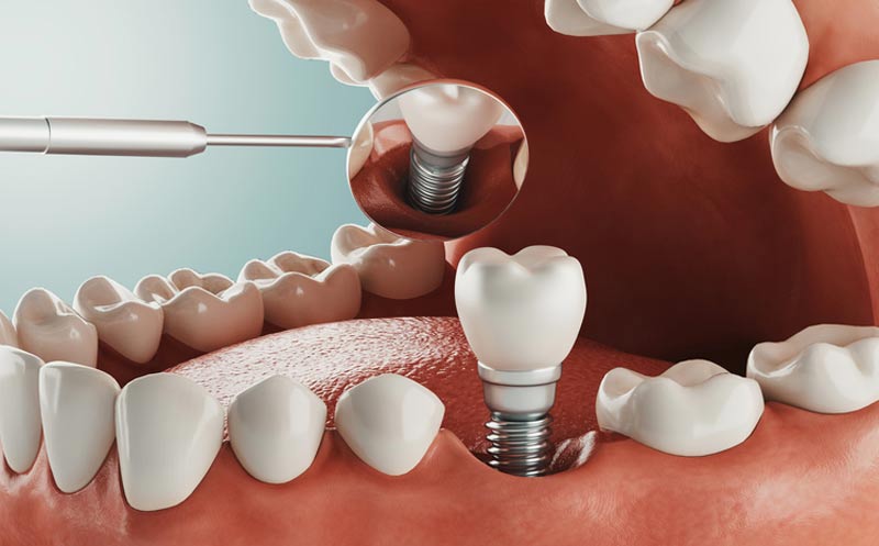 implantes dentales Lanzarote