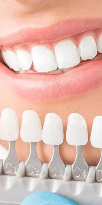 Carillas de Composite estética denta Lanzarote